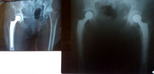 proteza in premiera 1